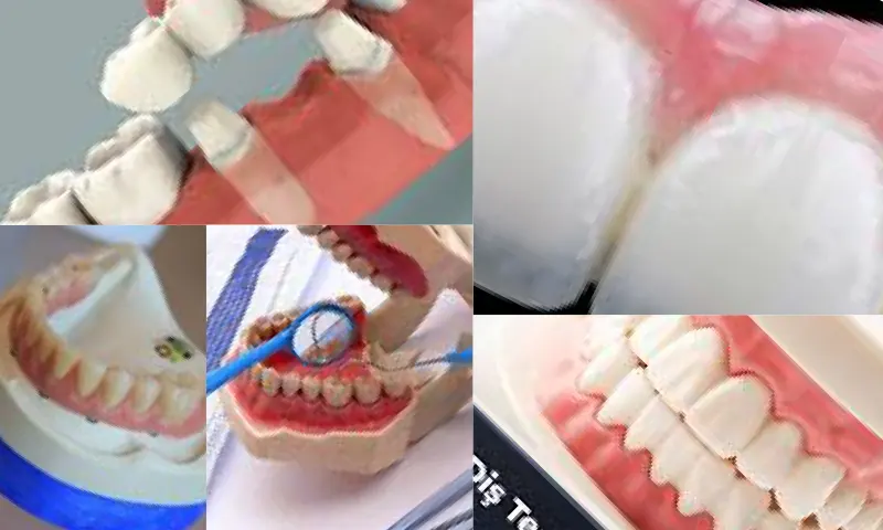 Protetik Diş Tedavisi Nedir