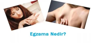 Egzama Belirtileri ve Tedavisi