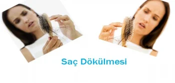 Saç Dökülmesi