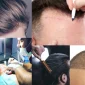 Choosing a Doctor for Hair Transplantation